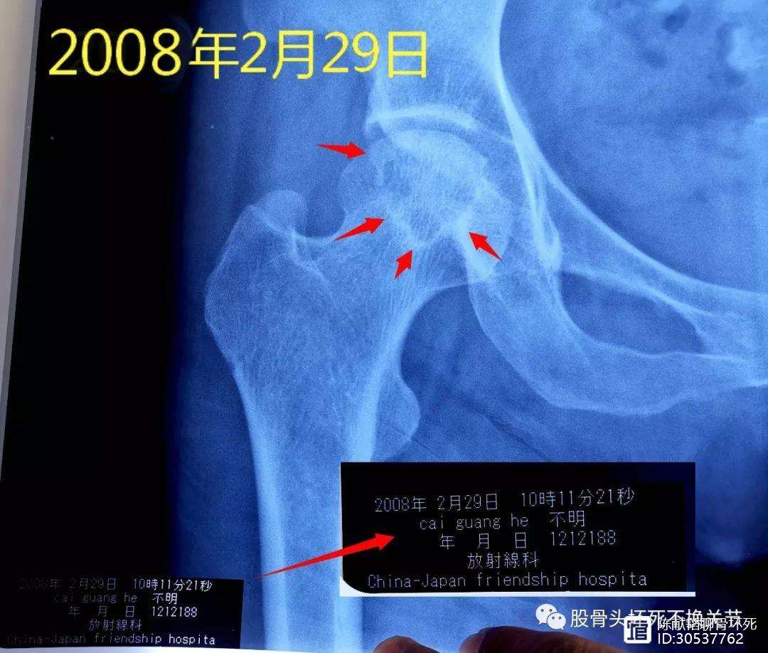 珠海人工骨头医保报销多少(人工骨头医保报销多少比例)